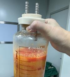 乐清水动力吸脂手术要做多久？